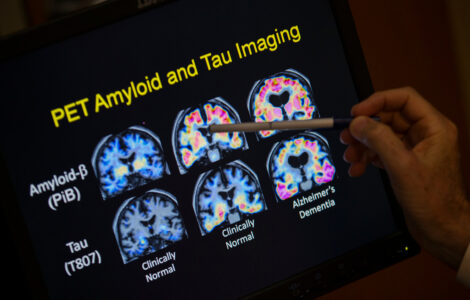Want to lower your risk of dementia? It doesn't involve a blood test